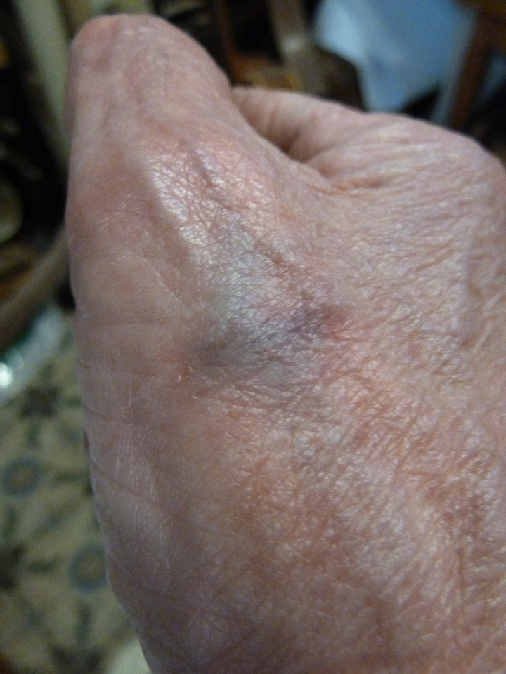 Yet another burst vein... Ogatodomar Blipfoto