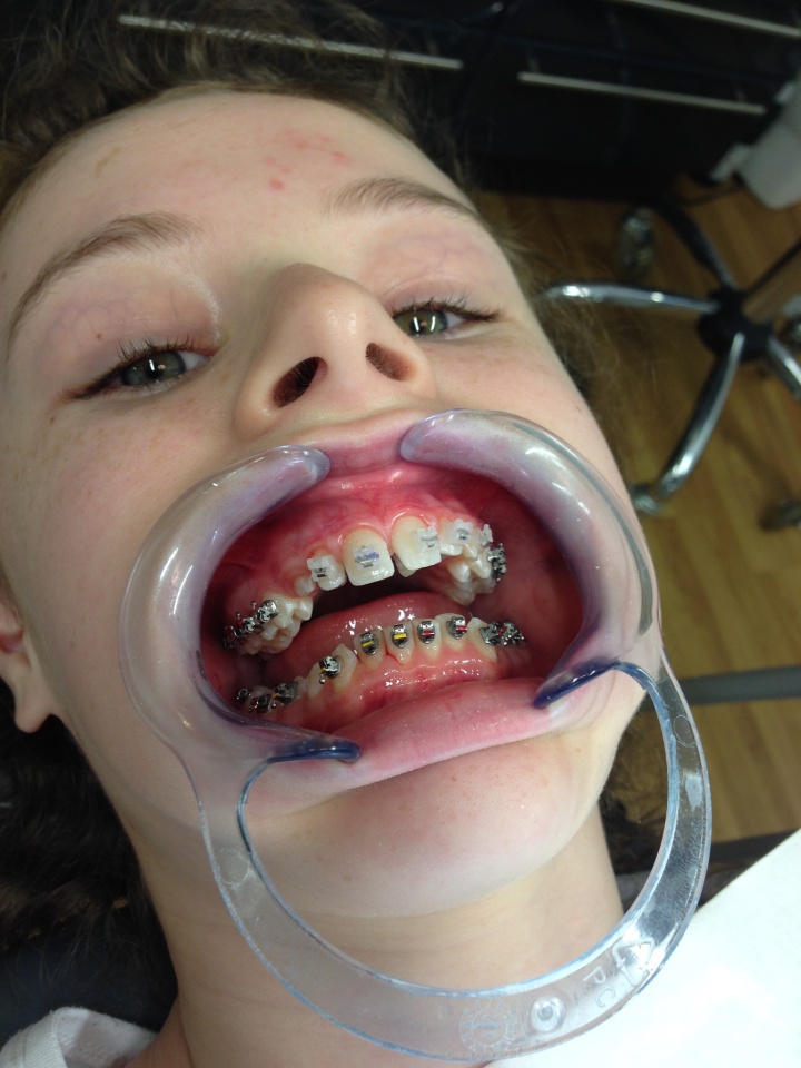 Brace Face MichiganFrau Blipfoto